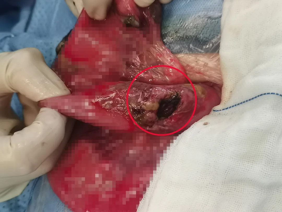 During surgery, a jejunal perforation about 2 cm in diameter was identified