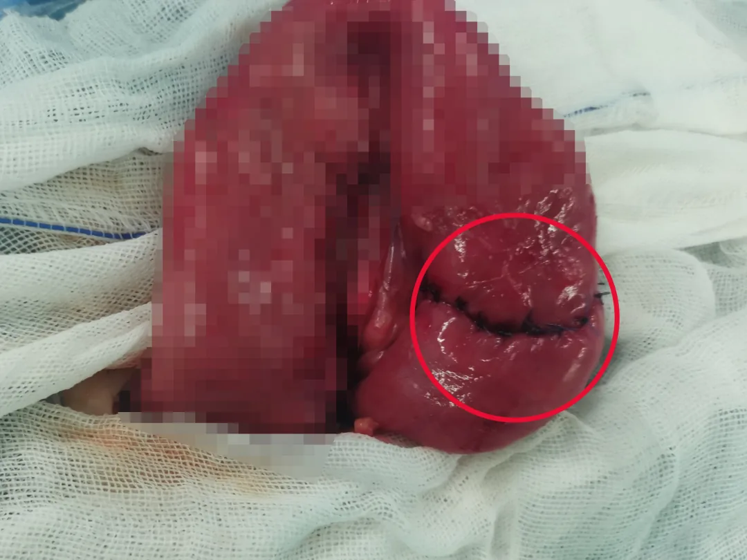 The bowel after removal of the ruptured segment and end-to-end anastomosis